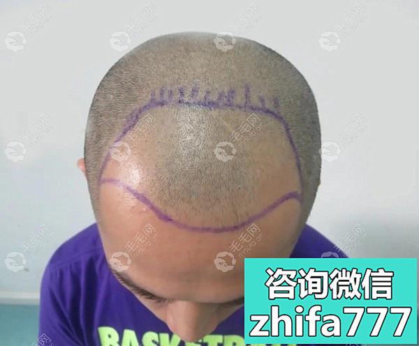 广州积美植发医院：男性头顶稀疏加密植发2500毛囊的真实案例