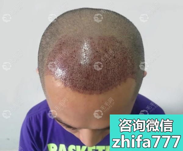 广州积美植发医院：男性头顶稀疏加密植发2500毛囊的真实案例