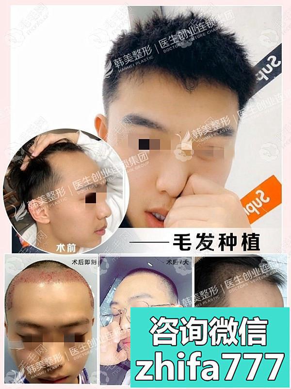 男士双额角植发六个月效果图！案例来源于怀化韩美植发医院