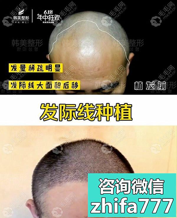 男士双额角植发六个月效果图！案例来源于怀化韩美植发医院