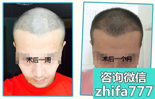 给大家亮下：我在东莞做头顶头发加密种植半年和一年的效果