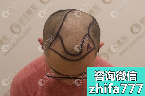 地中海植发案例：头顶加密植发3300毛囊避免了秃头的尴尬