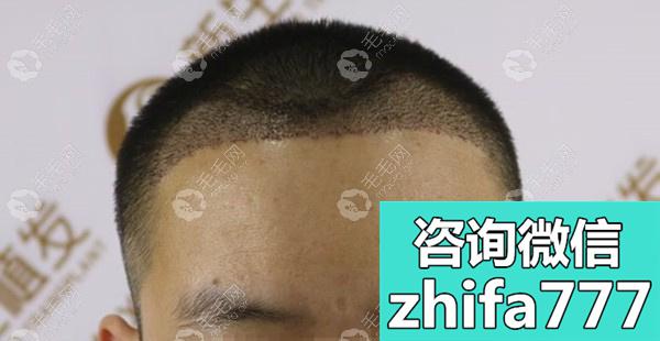 一直担心植发伤害大脑神经的我为什么去贵阳新生种头发了？