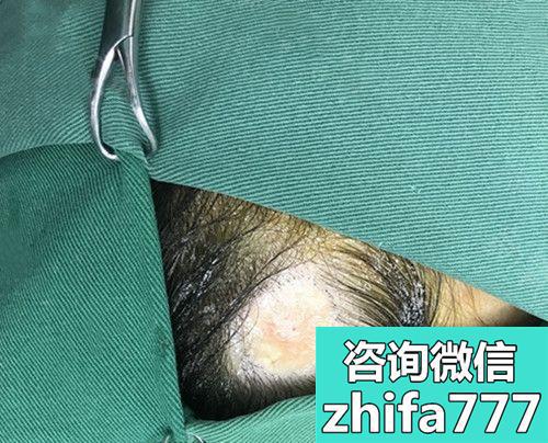 在深圳非凡植发做了额角种植来分享下我额角脱发恢复案例