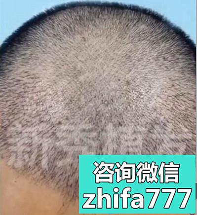 南京新秀植发董艺娜发际线额角种植2500单位6个月效果图来了