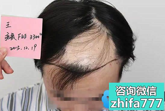 头上有疤痕能植发吗？来看天津雍禾疤痕植发案例及7个月效果