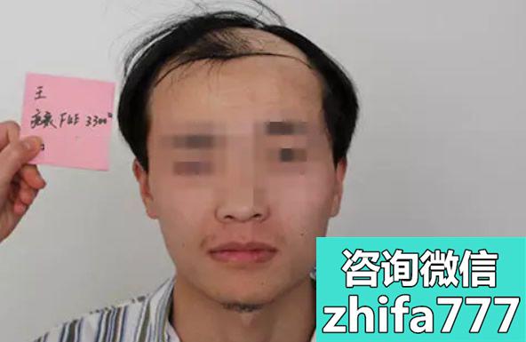 ​杨洲医生现在是合肥雍禾植发主任 这是他的疤痕植发案例