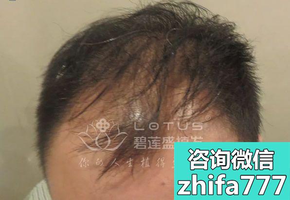 ​李先生二次踏入济南碧莲盛植发 请尹梓贻给他种头发