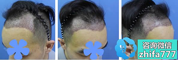 2017年我去柳州贞韩做了植发手术，7个月让我告别了m型发际线