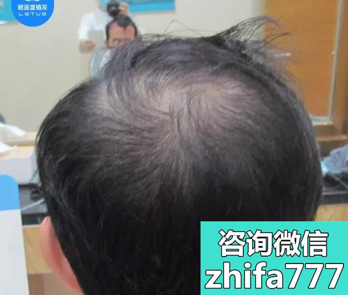 他是研究生发洗发水的，却在太原碧莲盛种植了2000单位植发