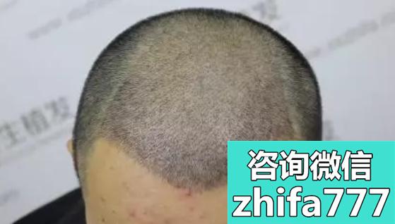 五级脱发还能植发吗？透露我在珠海新生五级脱发植发效果图