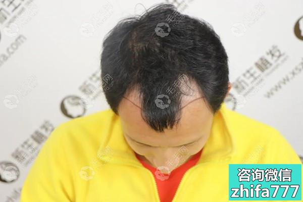 都说厦门新生正规又靠谱，遗传m型脱发发友植发3000单位试水