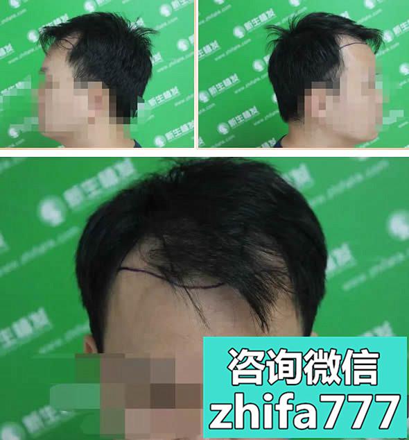 我被诊断为四级脱发，在上海新生花39860元种植了前额发际线