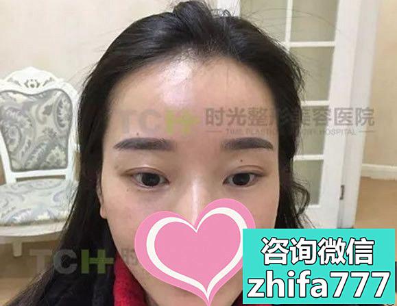 看看重庆时光毛发移植医生杨杰给女士种植发际线的效果图