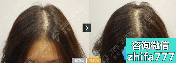 江西广济医院植发案例 女性头缝宽实施头发加密手术