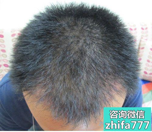 武汉大麦发际线种植，终于可以随意变换发型了