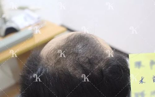 张先生两额角脱发5年微针植发效果
