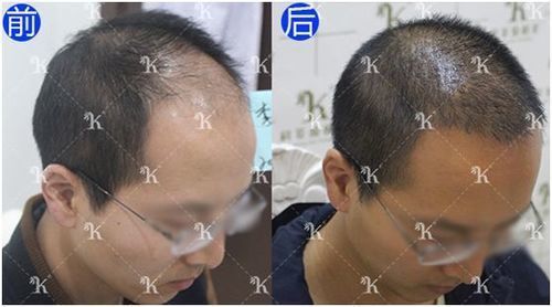李先生头发掉了半头植发5个月后效果