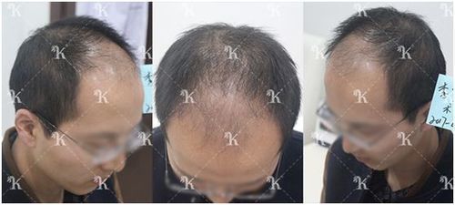 李先生头发掉了半头植发5个月后效果