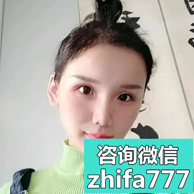 厦门新生美人尖种植案例分享