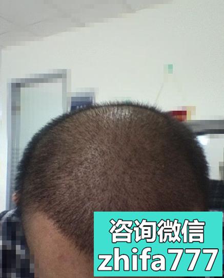 天津熙朵秃顶植发案例分享