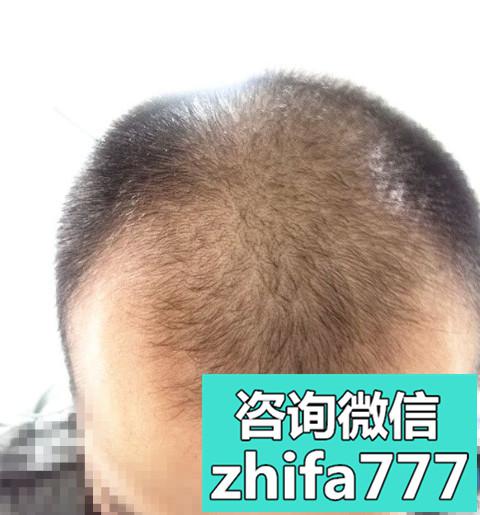 天津熙朵秃顶植发案例分享