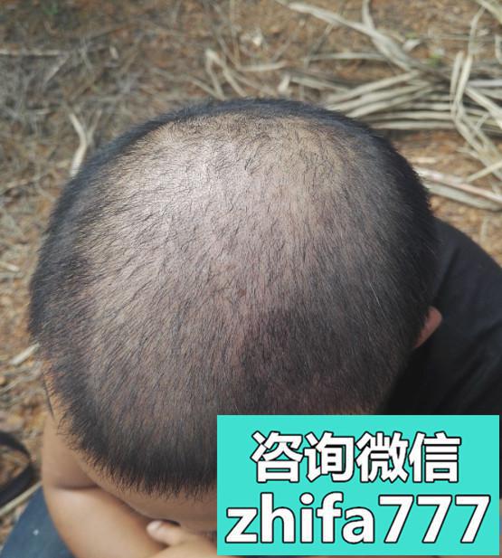 西安元邦发际线种植术后分享