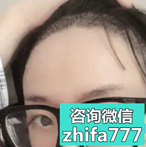 长春中妍发际线种植很满意