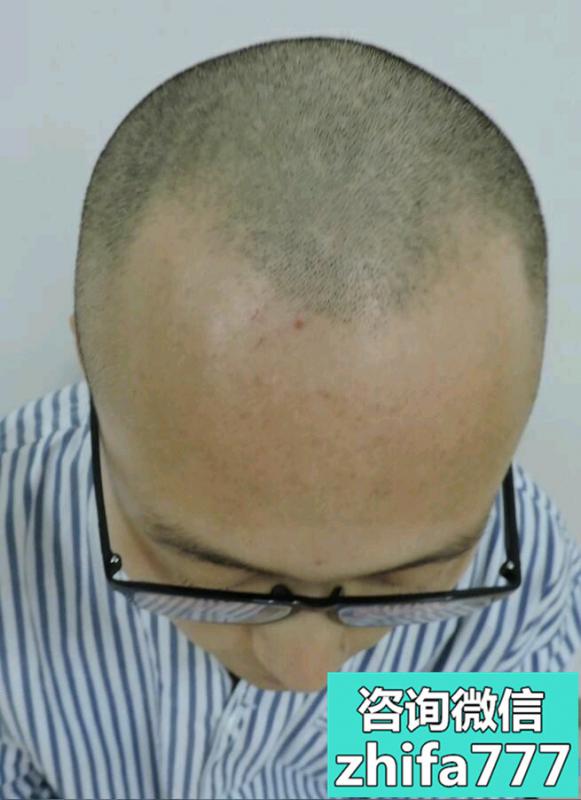 重庆碧莲盛秃顶植发术后效果分享来了