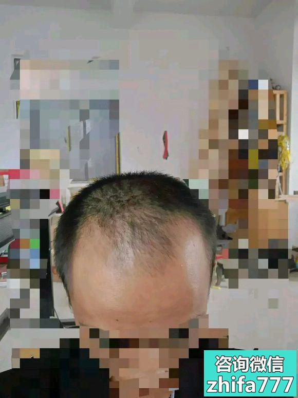 杭州新生秃顶植发术后分享