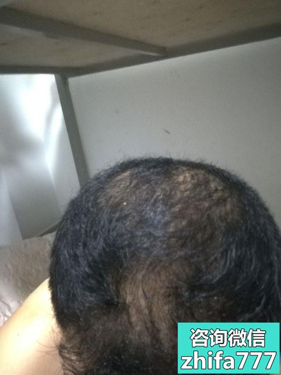 昆明新生秃顶植发术后效果分享案例
