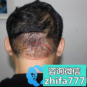 大连京城疤痕植发效果图片解惑25年的头部烫伤能植发吗？