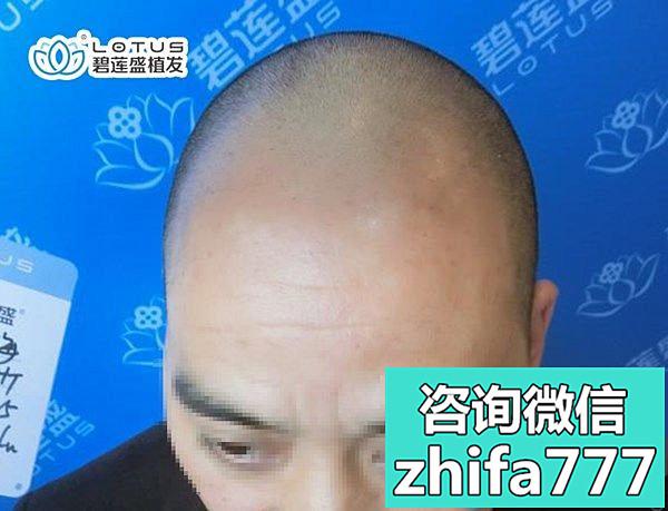 来get下西安碧莲盛植发医生张桥植发2000单位的效果怎么样！