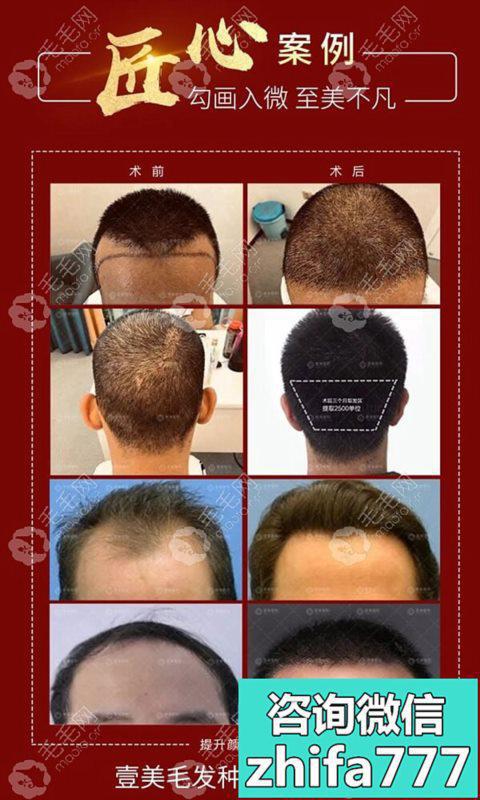 因发际线太高做了前额植发：请看40岁男人种植头发后的效果