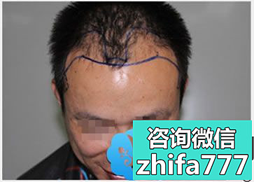男子5个月前在海口华美医院进行种植发际线了，植发效果揭晓