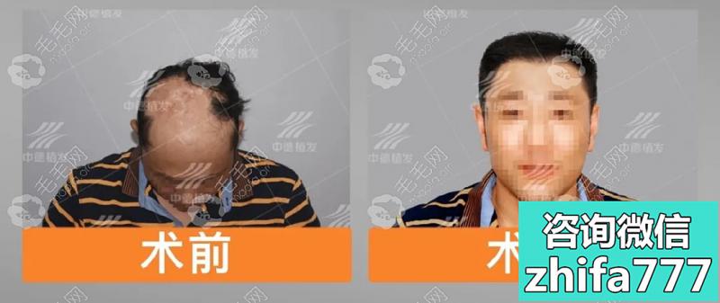 在北京中德毛发医院做疤痕植发的价格是多少钱？效果怎么样？