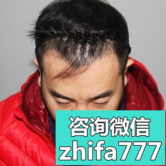 北京中德毛发移植医生徐霞为男化妆师种植发际线效果展示
