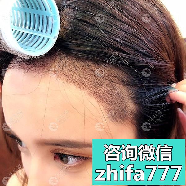 广州荔医用CBBD技术种植发际线2500毛囊多少钱？来看我效果图