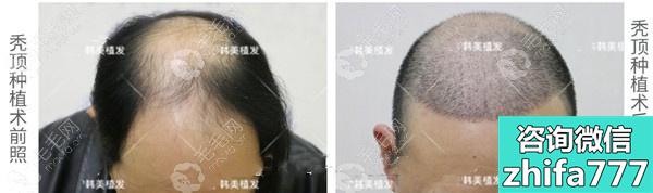 海南植发案例：分享40岁刘先生做秃顶植发六个月的效果图片