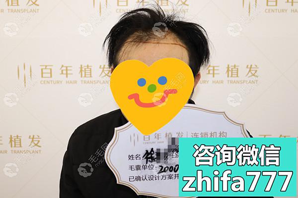 种植前额要多少根头发？在无锡百年种了2000毛囊，屌丝逆袭了