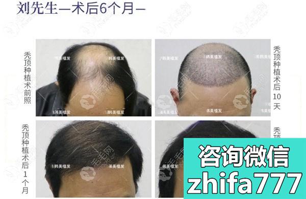 海南植发案例：分享40岁刘先生做秃顶植发六个月的效果图片