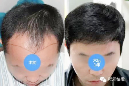 上海植发医院头发种植2850单位效果