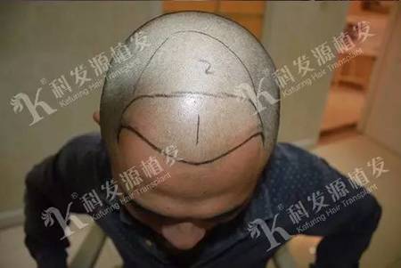 头顶稀疏加密植发6个月后实力挽救！