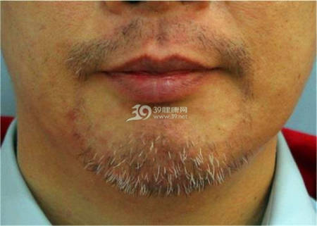 男士胡须种植加上眉毛种植效果案例