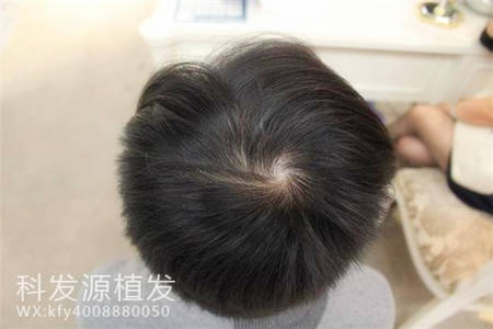 朱先生3487单位上海加密植发告别M型脱发