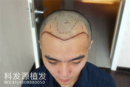 朱先生3487单位上海加密植发告别M型脱发