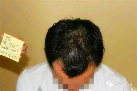 郑州男士3100单位植发6个月恢复情况
