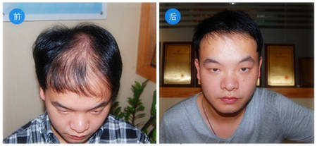 广州老师选择头发加密进行植发修复