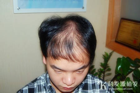广州老师选择头发加密进行植发修复