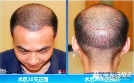 广州六级脱发大面积植发真实效果